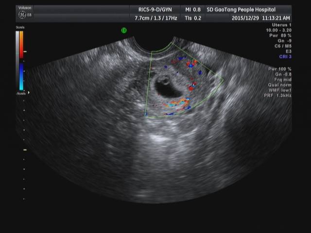 超聲殘角子宮及殘角子宮妊娠