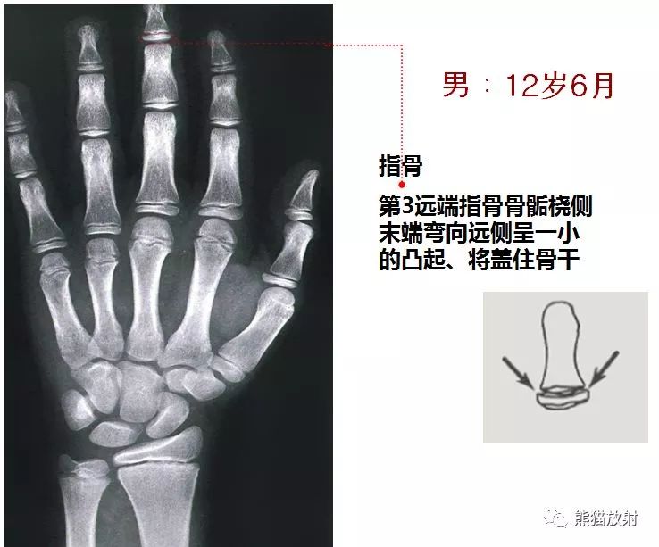 骨齡圖譜保存隨時對照查看