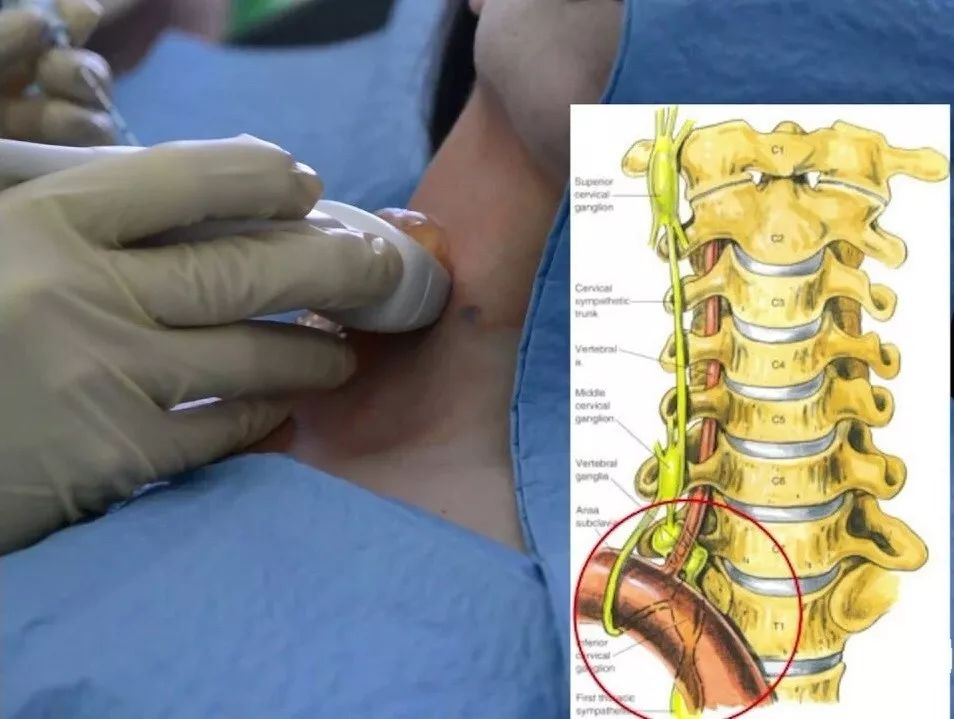 颈椎星状神经节阻滞术图片