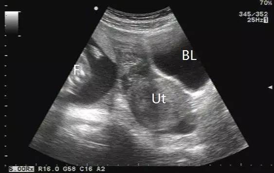 宫腔内残留物b超图片图片