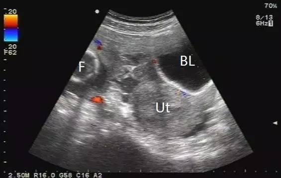 残角子宫超声图图片