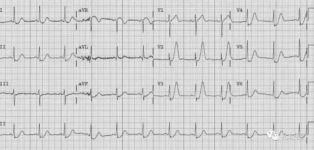 dewinter心电图图片