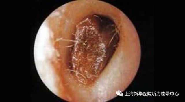 但 由於掏耳不當等原因,耳垢堆積較多且被推入耳道深部後,可能會 堵塞