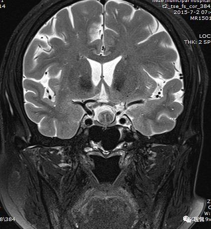 垂体rathke囊肿你见过这种影像表现吗注意鉴别诊断