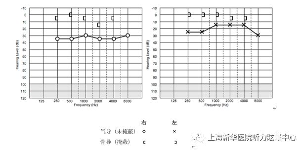 视频耳内镜结果提示双侧分泌性中耳炎,声导抗鼓室图为双侧b型