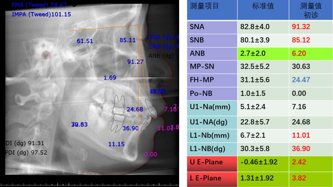 病例分享l數字正畸64奧世美03orthguide03