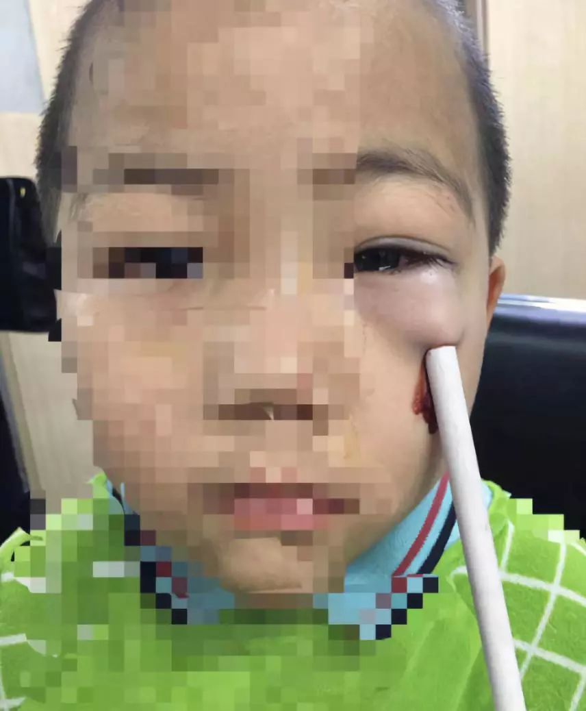 儿童铅笔扎眼睛图片图片
