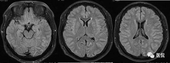 mri 示t2 flair双侧大脑半球脑沟内见多发条状稍高信号,余序列未见