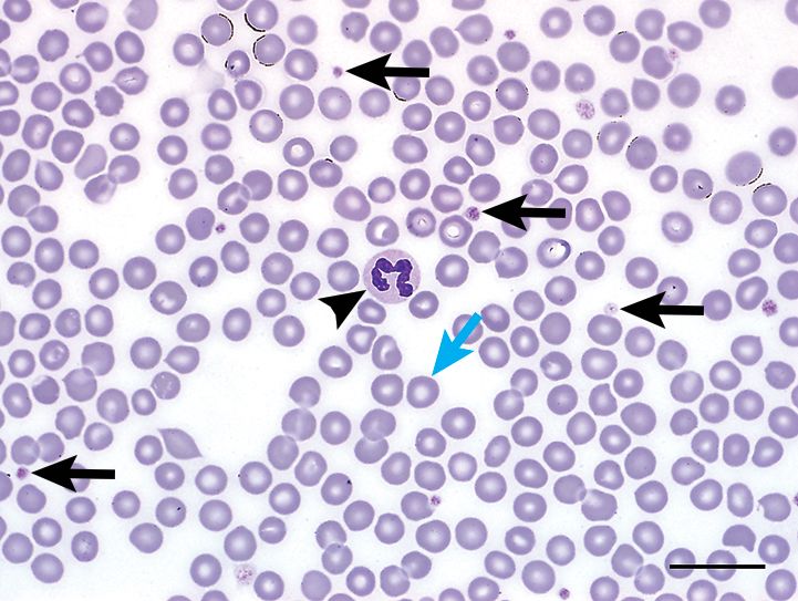5张经典血涂片全面解读再生性贫血