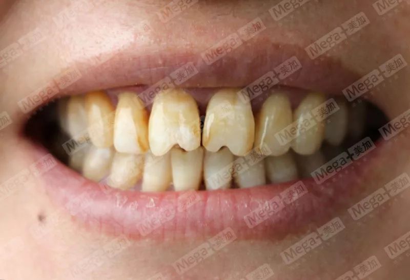 有一种牙齿缺损叫瓜子牙