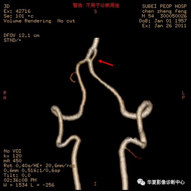 头颈部动脉开窗畸形