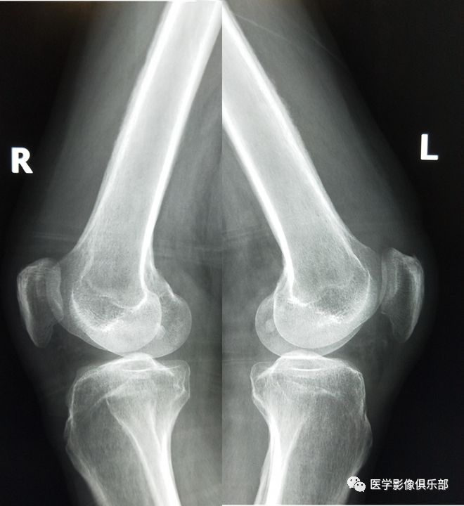 股骨病变哦原来是它