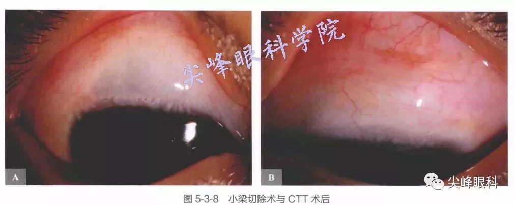 与儿童青光眼手术相关的问题并发症及处理问题解答part