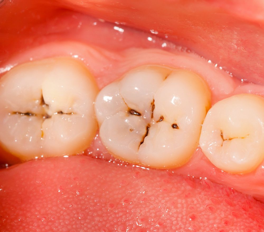 牙齿上有小黑点到失去牙齿要多久?