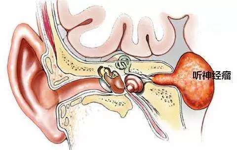 耳石症的诊断与治疗