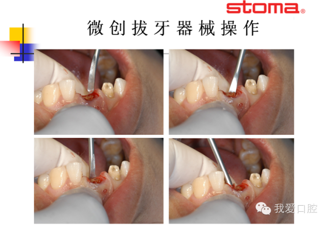 隙是造成患者不适的主要原因,另外使用传统牙挺拔牙是通过使用杠杆力