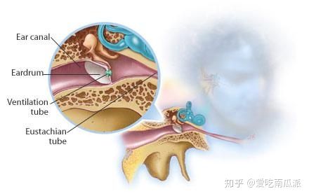 鼓膜穿孔后能自动愈合吗需要多久