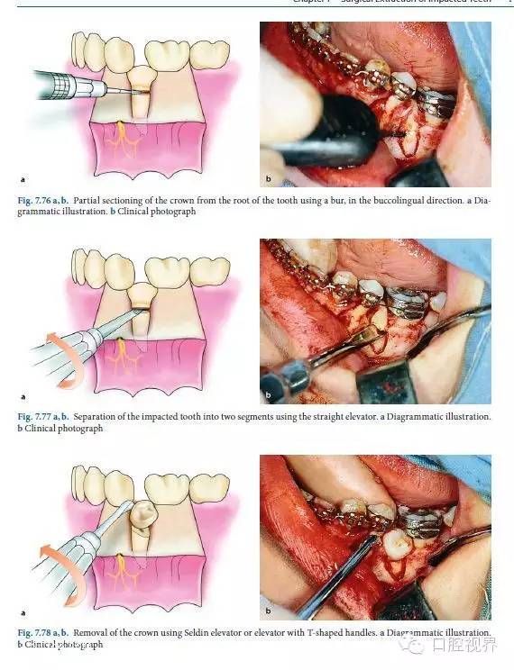 拔牙过程图解图片