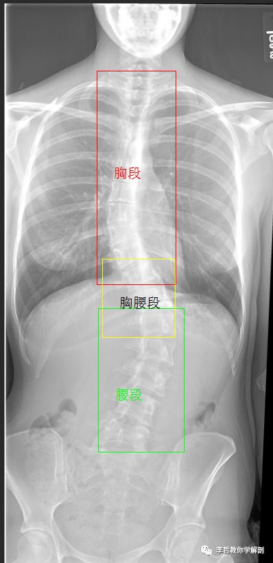 胸椎侧弯角度图片