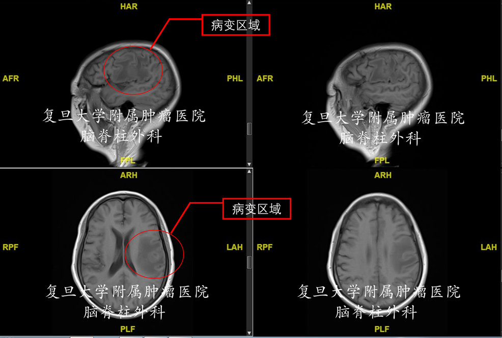 61初步診斷:61輔助檢查:頭顱mri所見: 左側顳葉佔位,約19*18mm