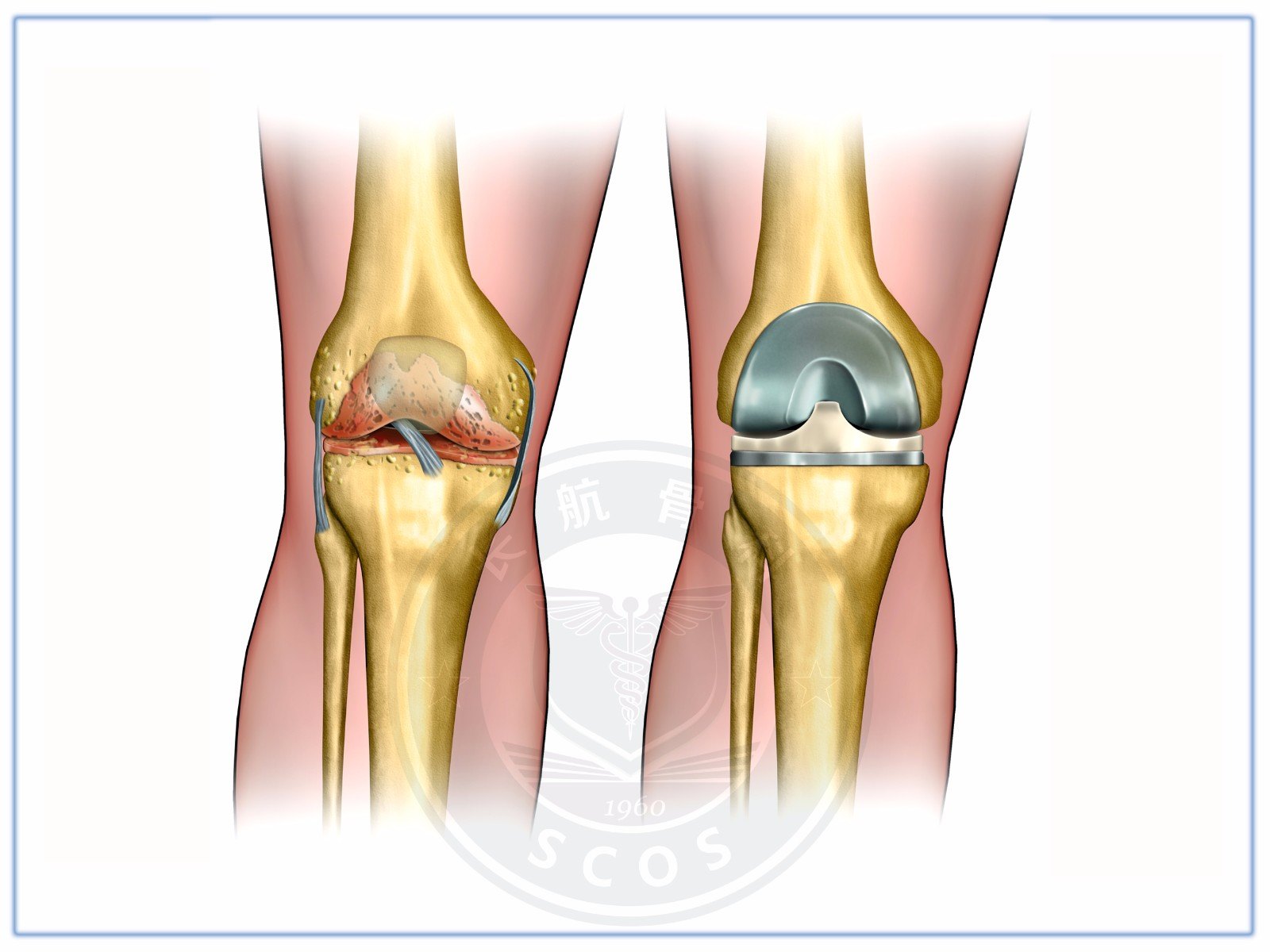 膝关节置换术后为什么刀口下外侧麻木,像"硬木块"一样 (原创)_切口