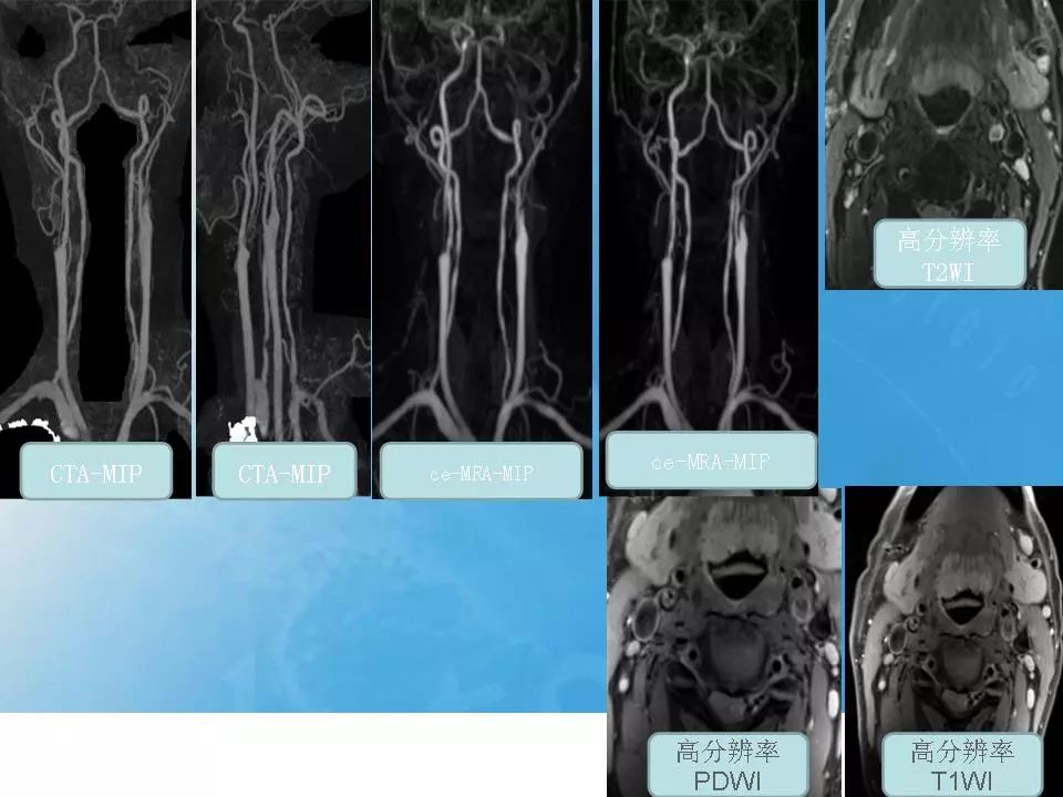 頸動脈cta及mra評價