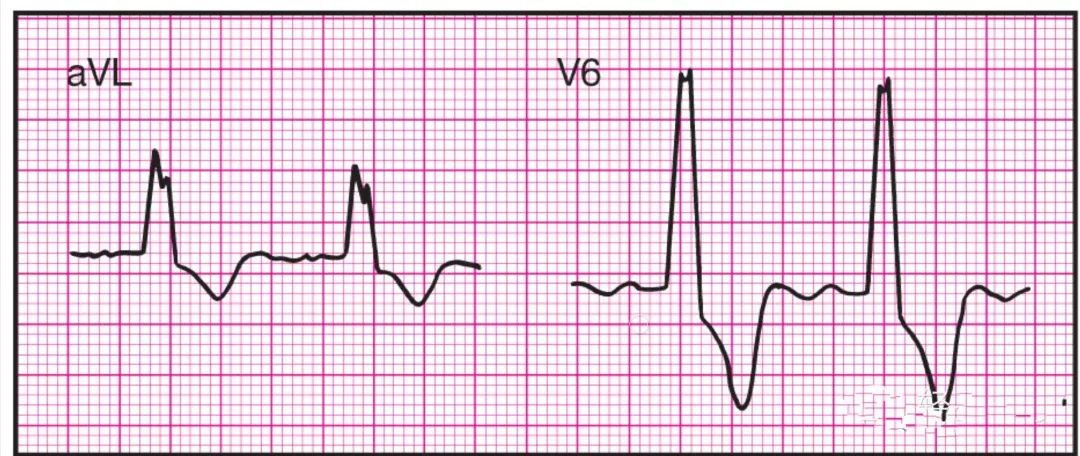 14种异常心电图图片