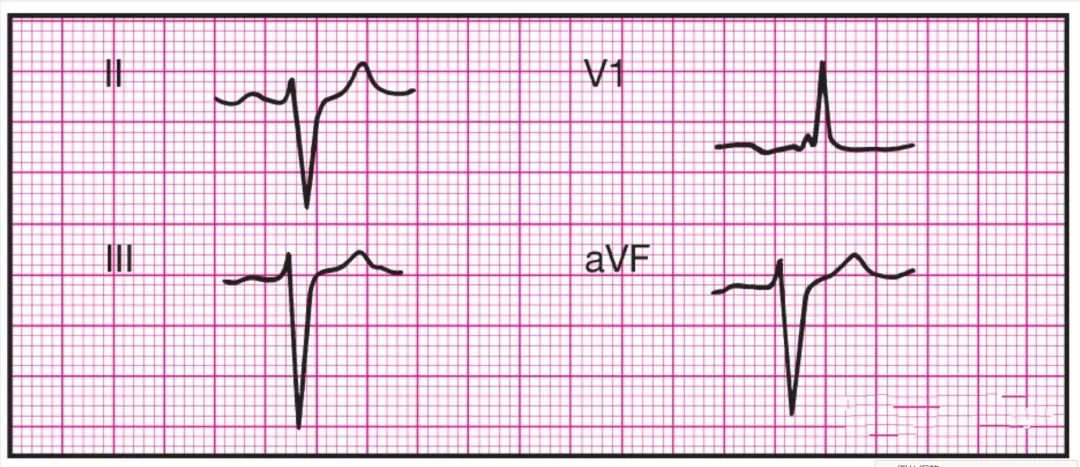 14种异常心电图图片