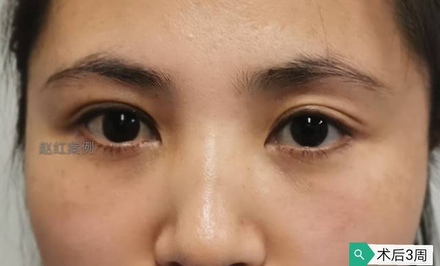 上睑下垂眼睛小很烦恼,但眼睛过大何尝不是困扰? (原创)