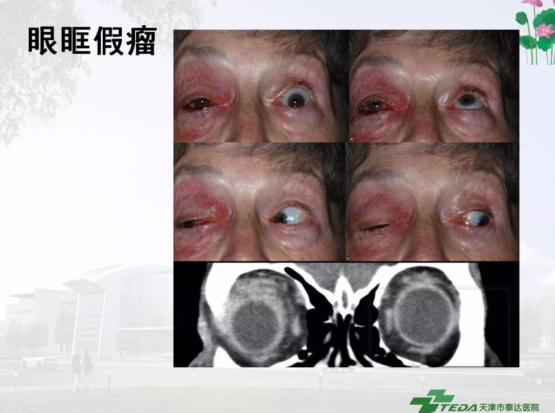 复视的诊断思路