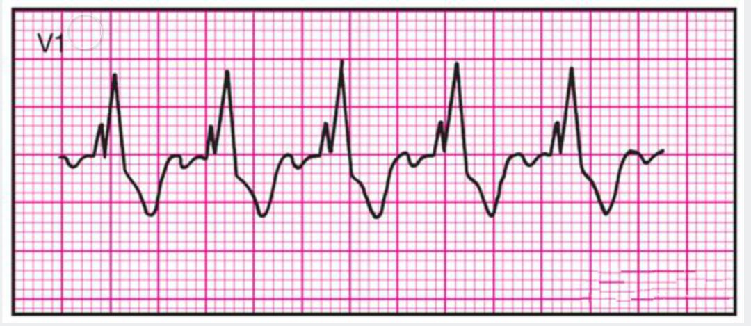14种异常心电图的波形特点,护士们收藏好!