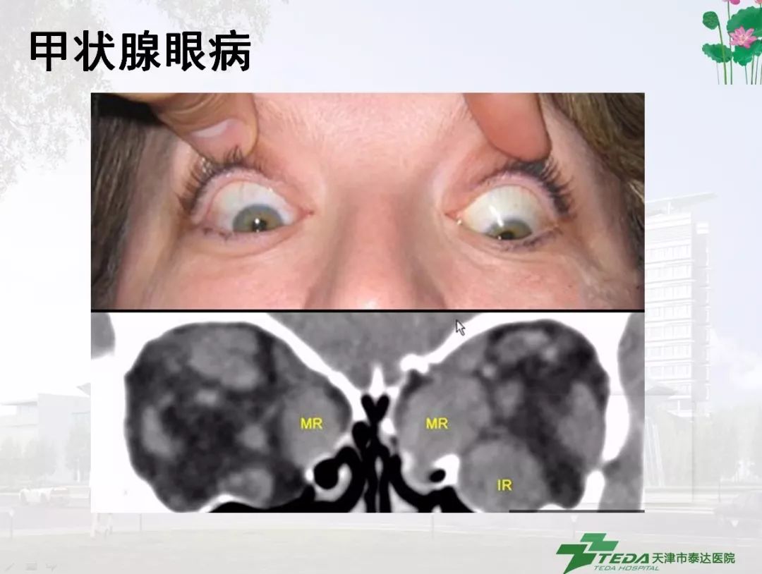 复视的诊断思路