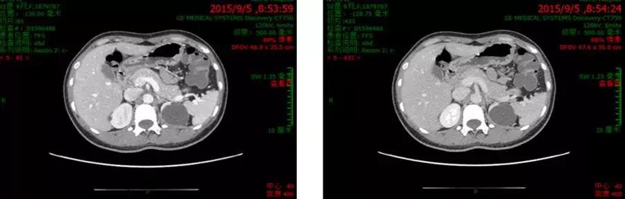 腹部ct胃癌图,胃t图片,胃胃镜图_大山谷图库