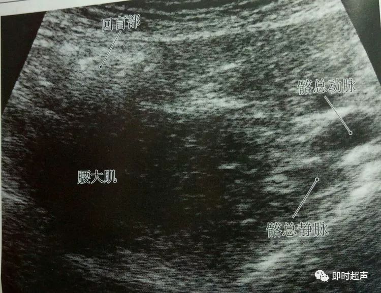超声诊断阑尾炎不再"雾里看花"_盲肠