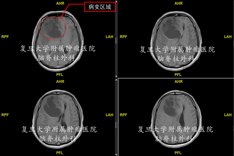 右侧额叶图片图片