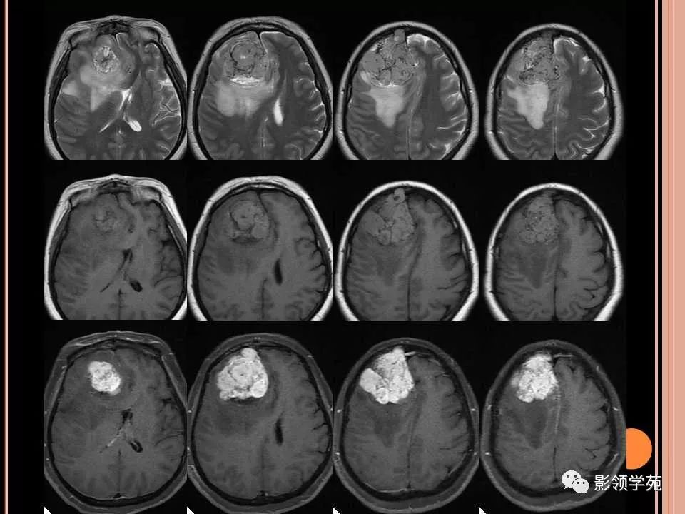 经典常见脑膜肿瘤影像诊断