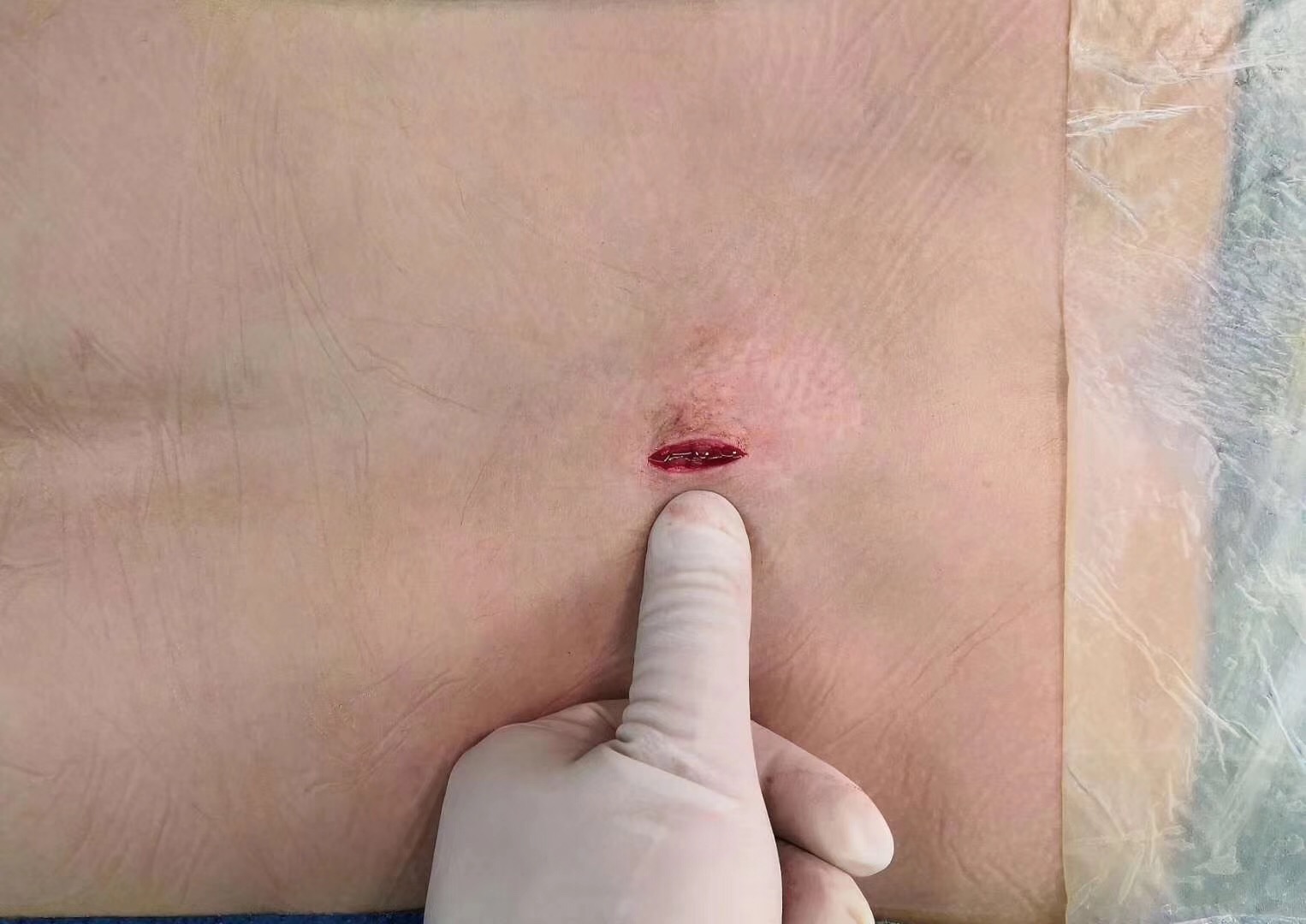 椎间孔镜微创术治疗腰椎间盘突出症