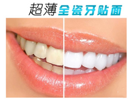 牙齿美白的技巧—瓷贴面_牙龈