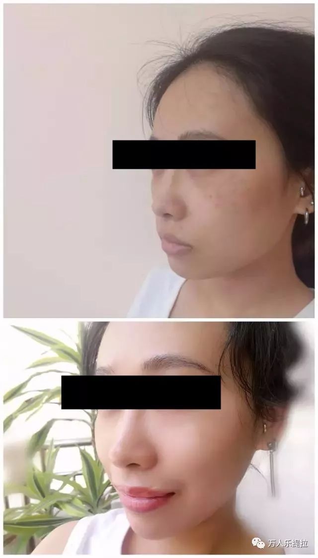 真实案例告诉你褐青色痣没那么可怕