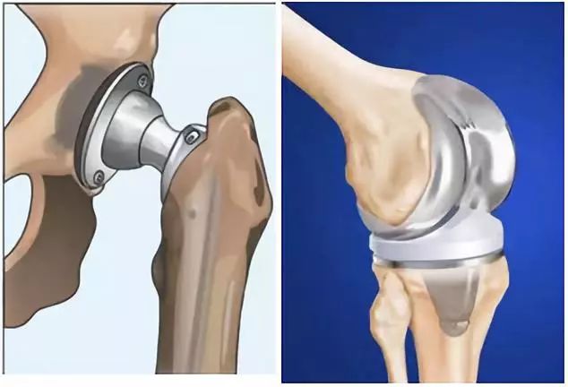 钛合金髋关节图片