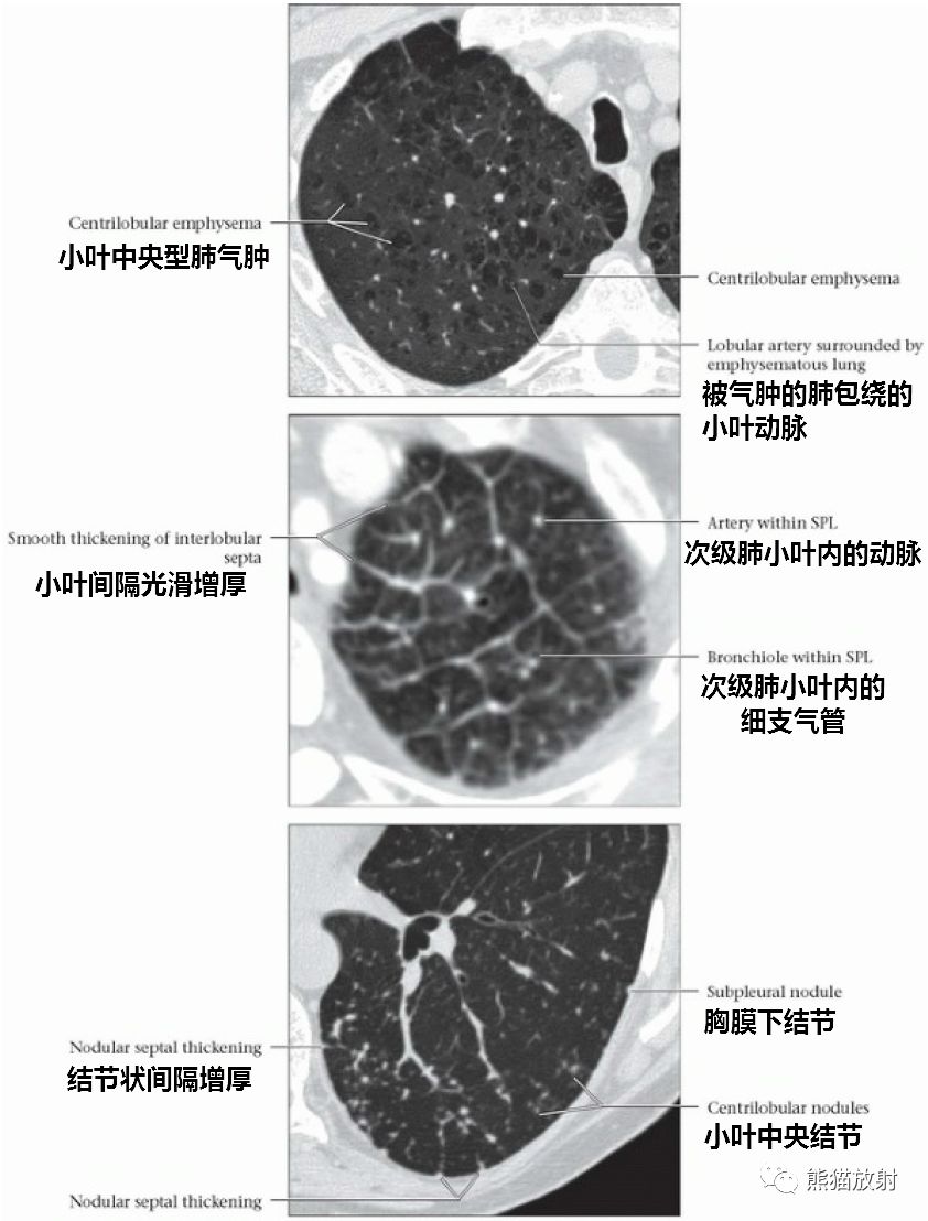 次级肺小叶丨解剖正常及异常影像