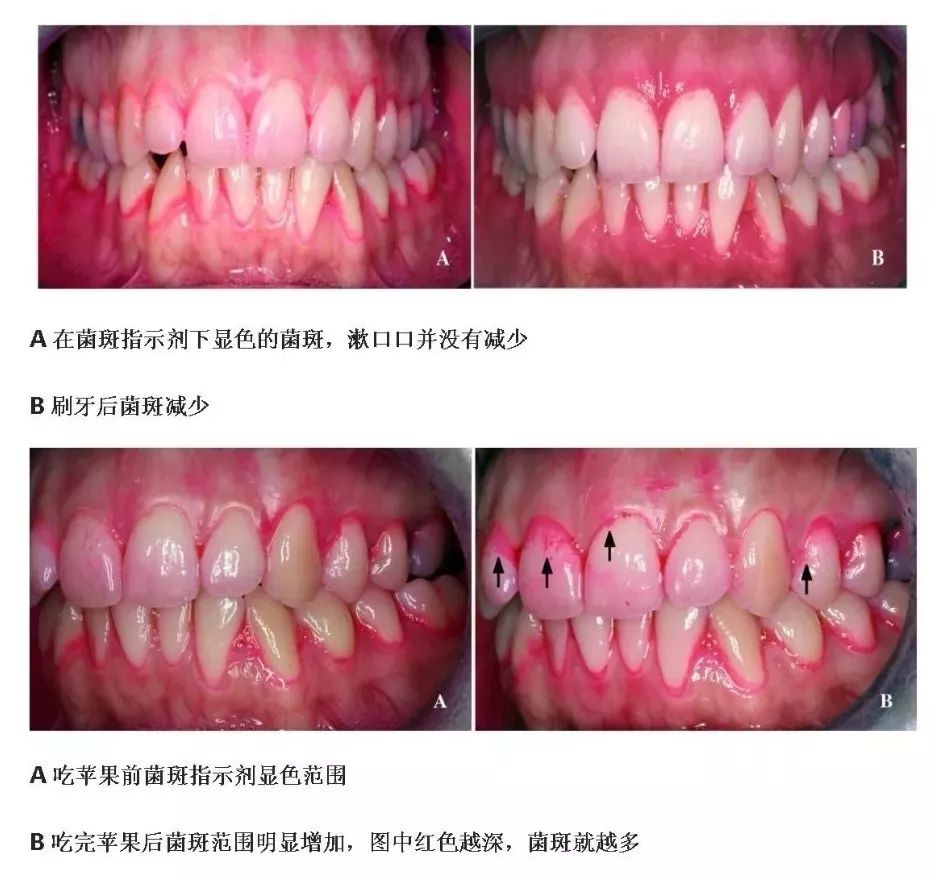 【健康】"该不该洗牙"也上热搜?亿万人关注的事,必须科普下