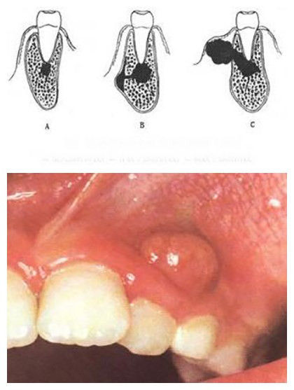牙槽骨遭到炎症影响,所以牙龈上才会鼓起一个脓包,从根尖到牙根的瘘管