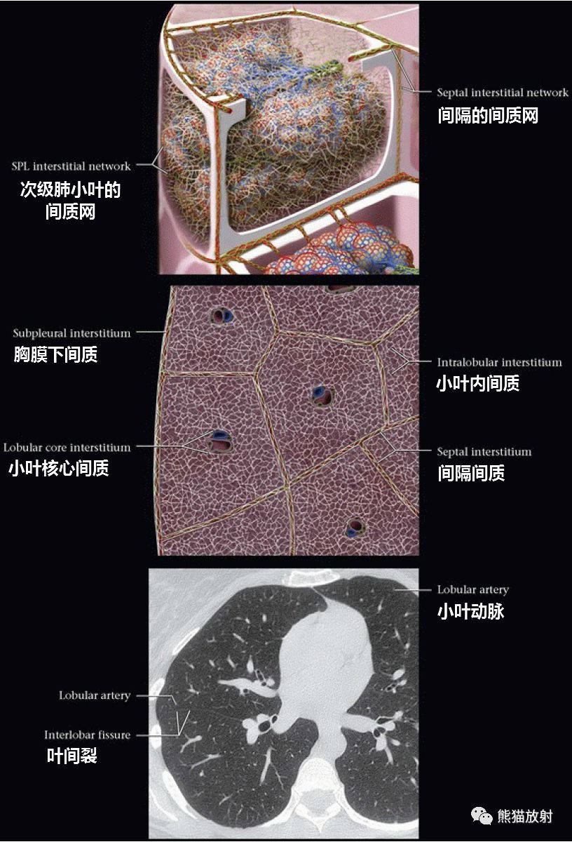 次级肺小叶丨解剖正常及异常影像