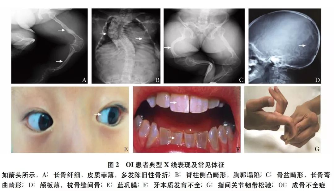 成骨不全患儿临床表现图源:夏维波,章振林,林华等,成骨不全症临床诊疗