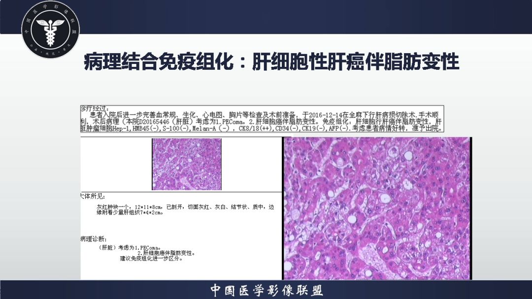 肝細胞性肝癌伴脂肪變性