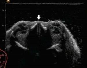 胎儿鼻骨超声检查_横切面