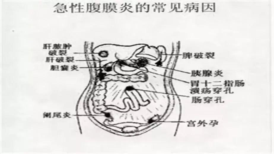 腹膜炎疼痛位置图片图片