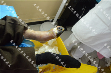 糖尿病足病情复杂要想避免截肢一定要接受专业治疗