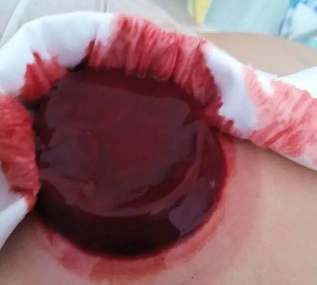 瘀血有两种:一种是一出体外,立刻凝固成果冻状;另一种是糖稀状的粘稠